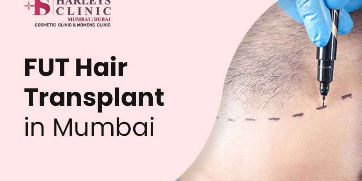 How Long Do FUT Hair Transplant Results Last?