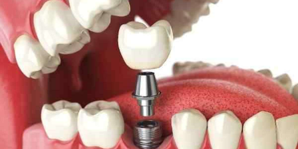 Dental Implants vs. Dentures and Bridges: Which Is Right for You?