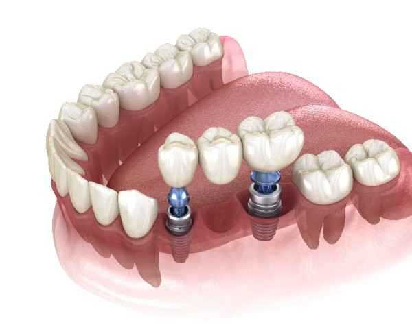 dental implant Derby