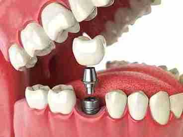 Image Source - Emergency Dentist Bury