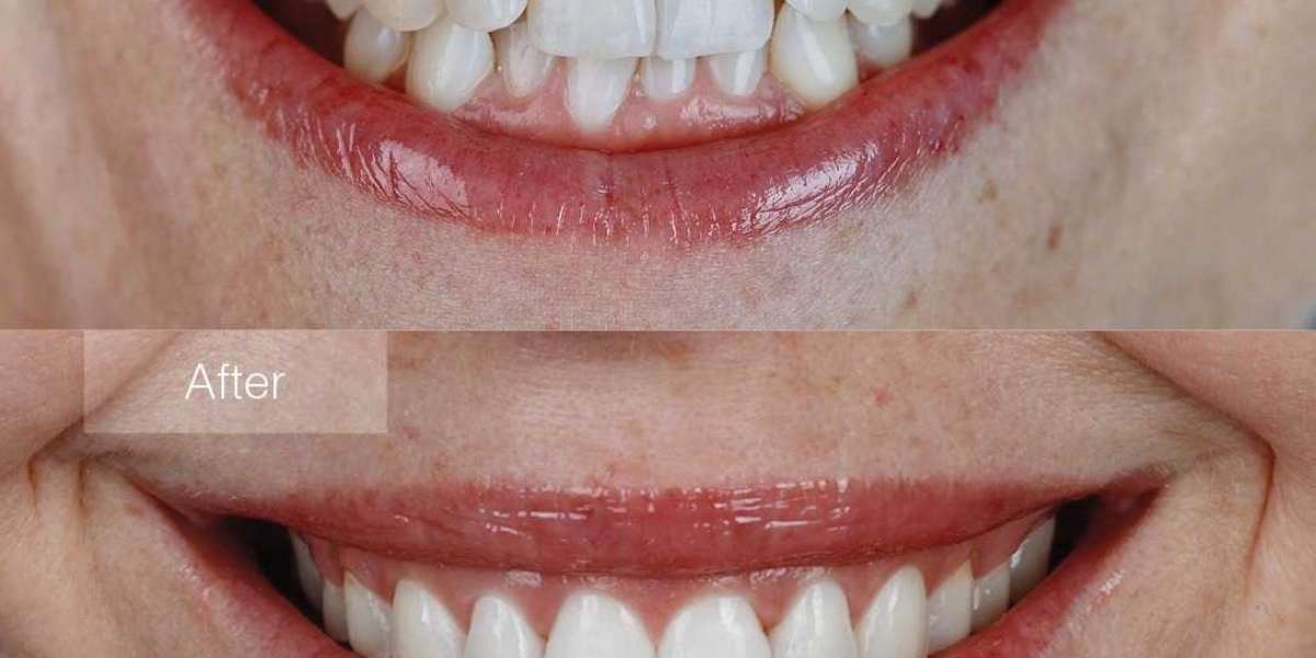Transforming Smiles with Kids Transparent Braces and Smile Correction Aligners in Jordan