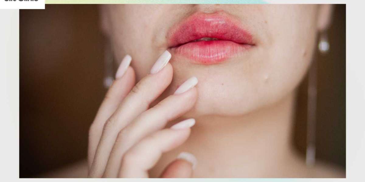 Lippen aufspritzen Schweiz – Für natürliche Fülle und Ausstrahlung