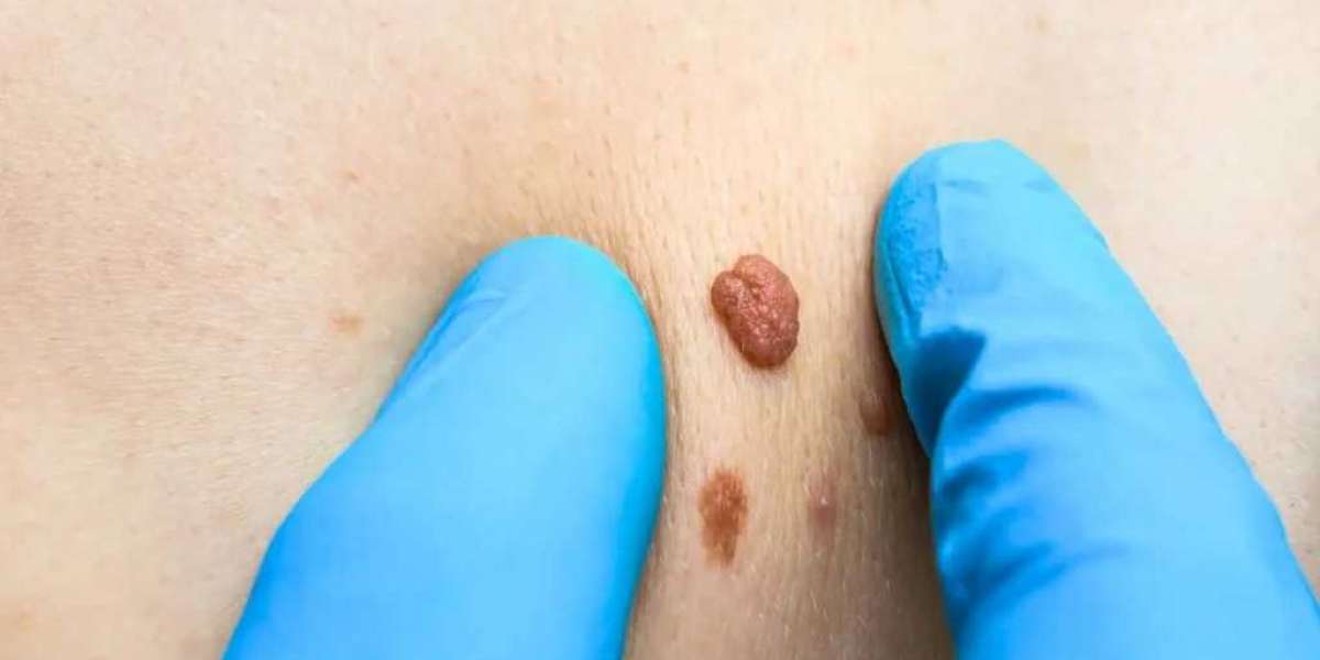 Who Should Get Skin Tag Removal in Dubai?