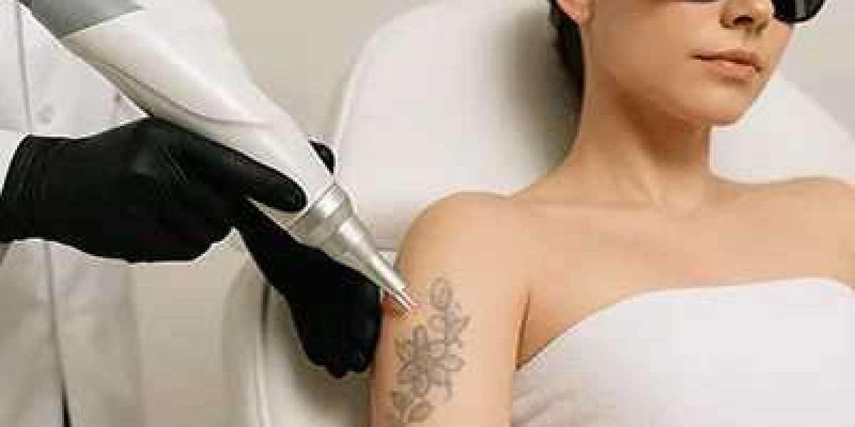 The Role of Q-Switched Lasers in Modern Tattoo Removal