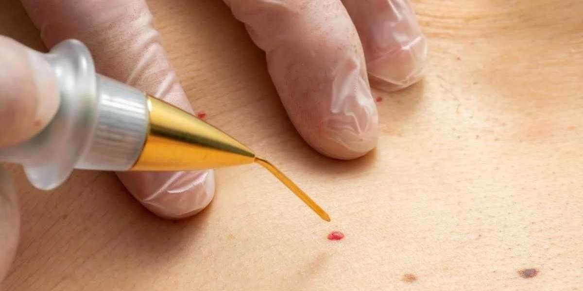 Who Can Benefit Most from Skin Tag Removal in Dubai?